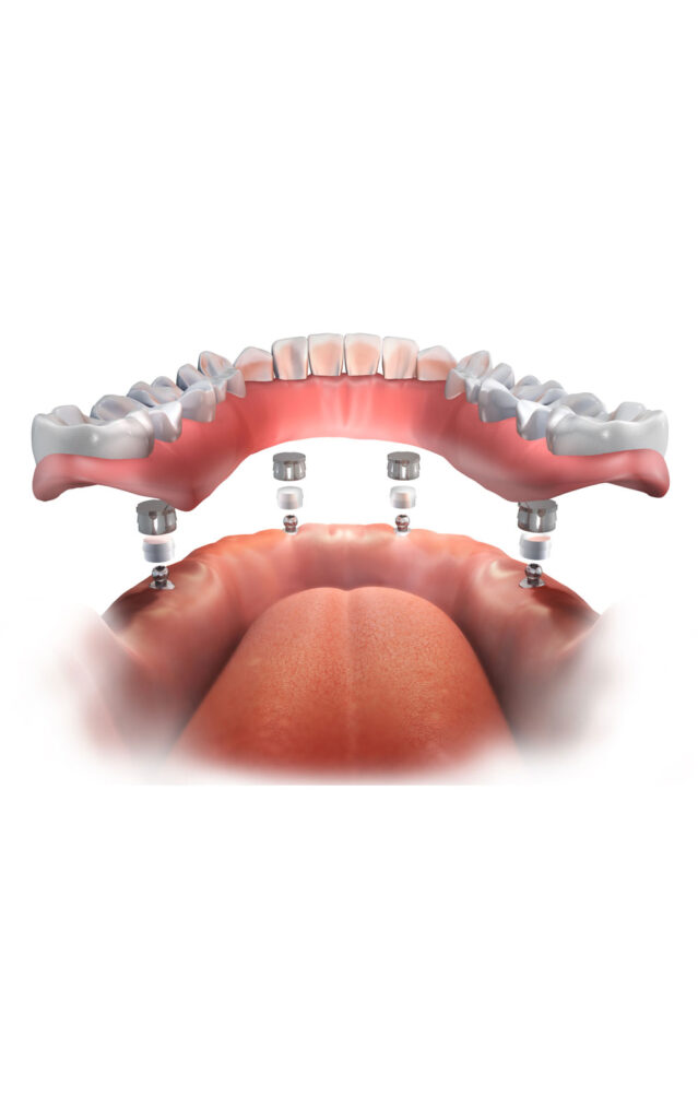 implant supported dentures